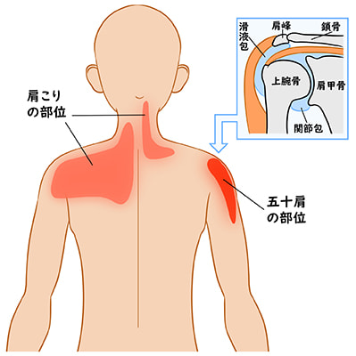 四十肩