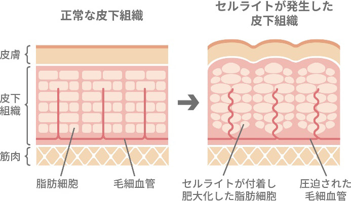 正常な皮下組織とセルライトが発生した皮下組織