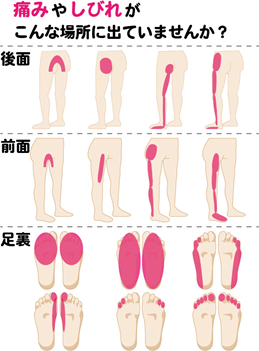 坐骨神経痛