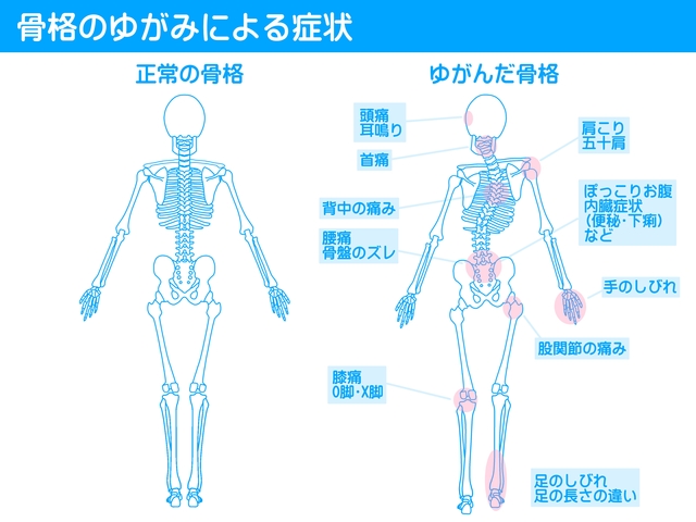 骨盤のゆがみによる症状